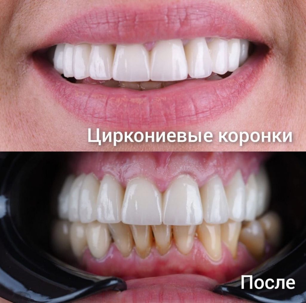 Циркониевые коронки (после) | 3D Стоматология Сочи
